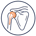 Knee Replacement