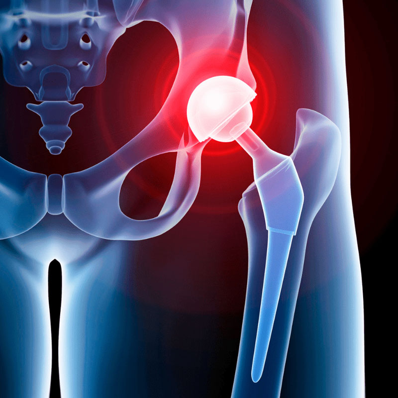 Joint Replacement Surgery