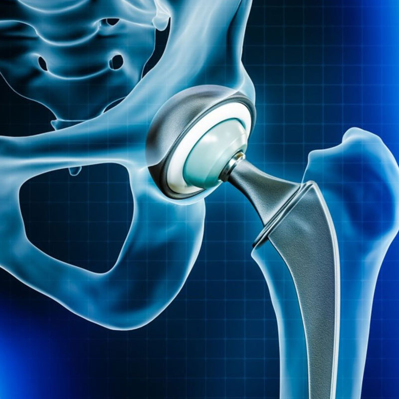 Hip Replacement